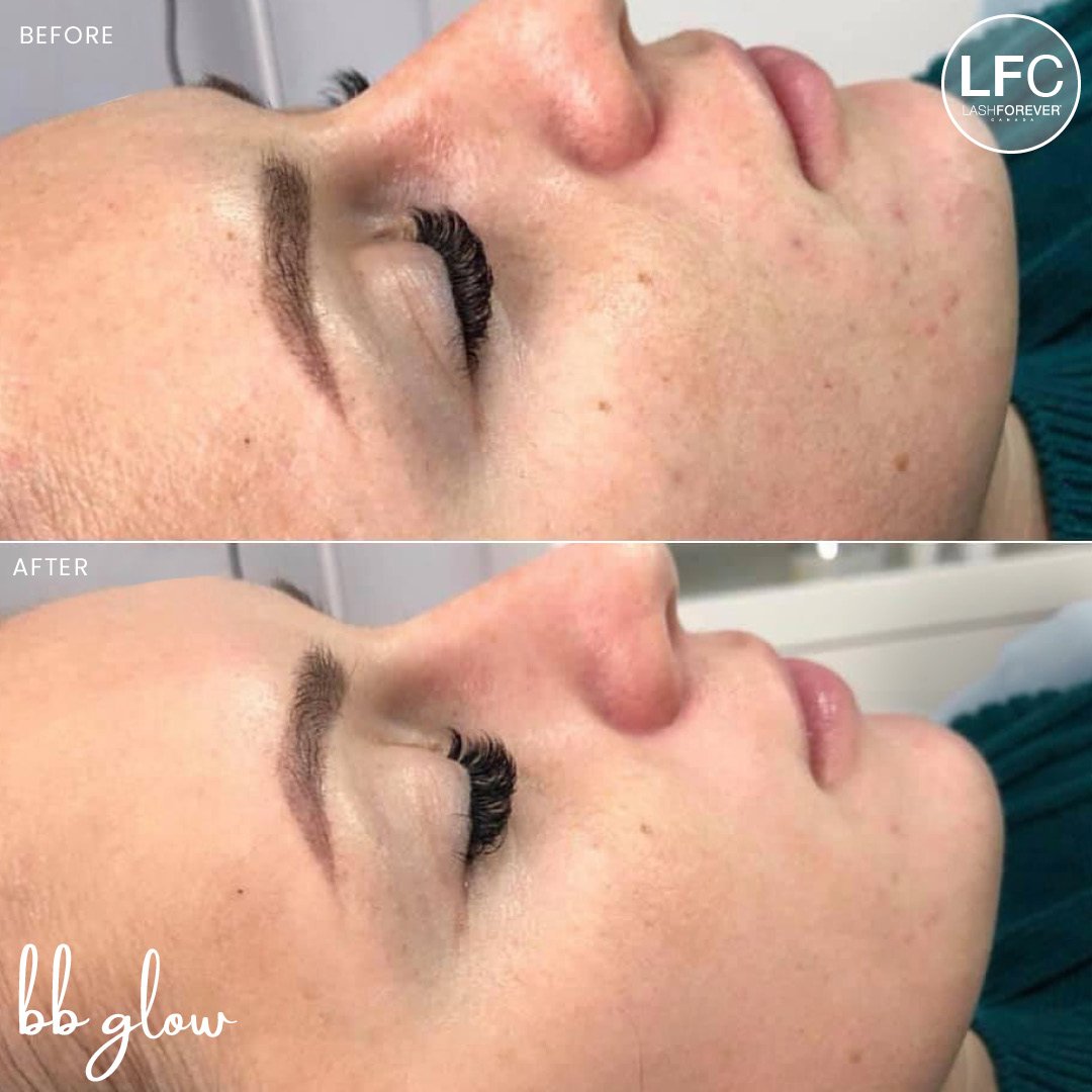 Mesotherapy by Dermedics Online Course-Course LASHFOREVER CANADA