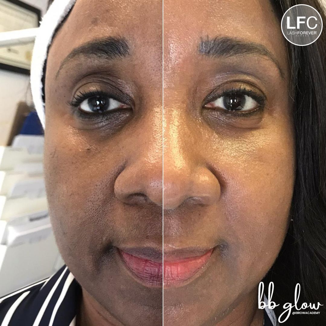 Mesotherapy by Dermedics Online Course-Course LASHFOREVER CANADA