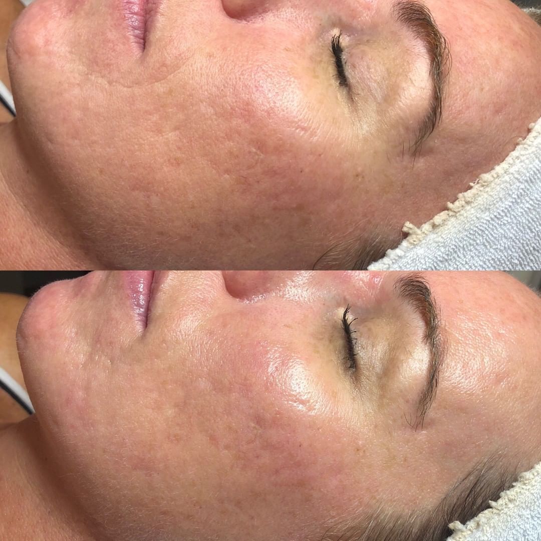 Mesotherapy by Dermedics Online Course-Course LASHFOREVER CANADA