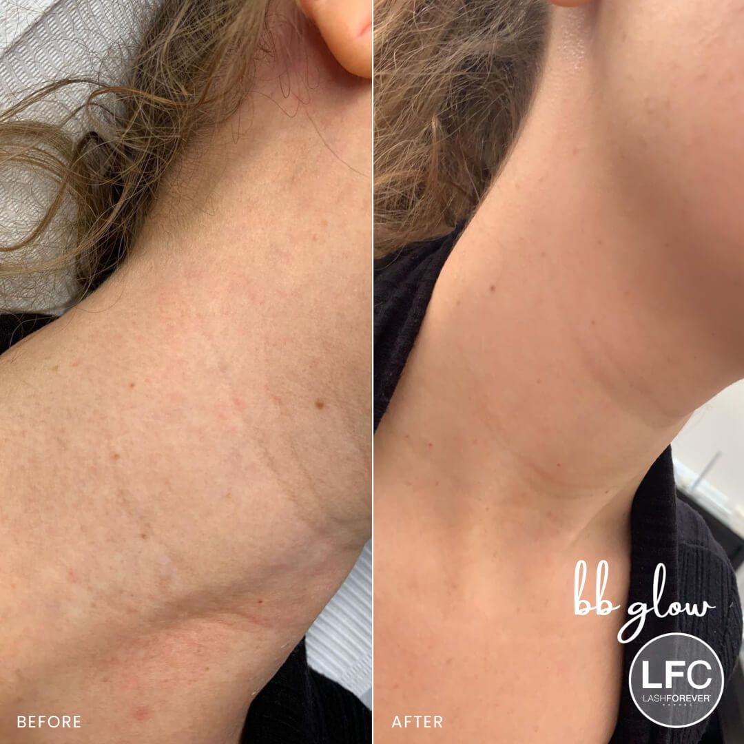 Mesotherapy by Dermedics Online Course-Course LASHFOREVER CANADA