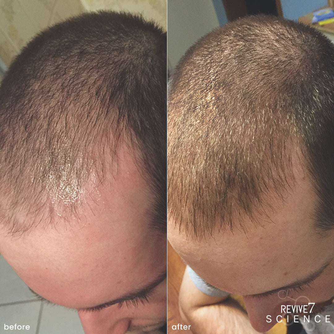 Revive7 Revitalizing Hair Treatment-Hair Loss Treatments LASHFOREVER CANADA