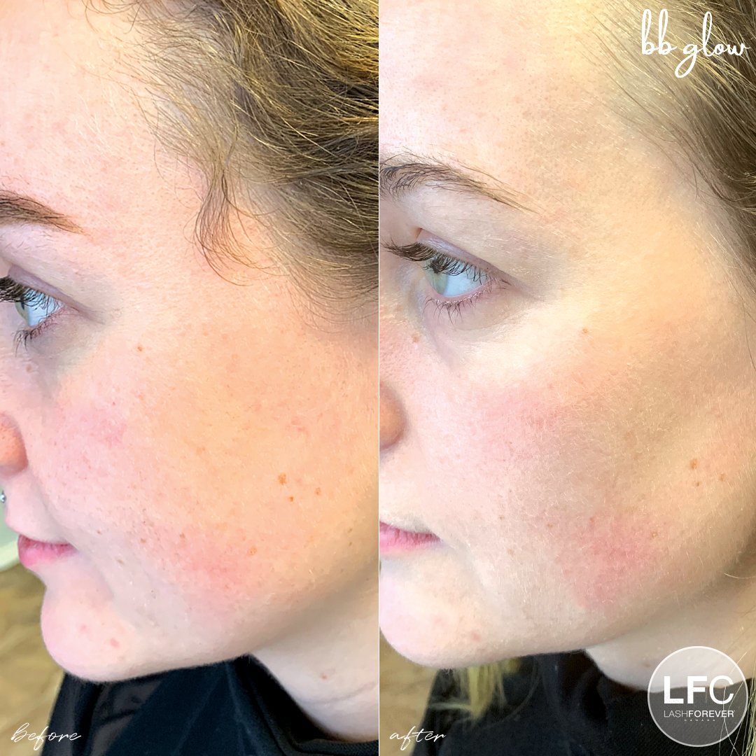 Mesotherapy by Dermedics Online Course-Course LASHFOREVER CANADA